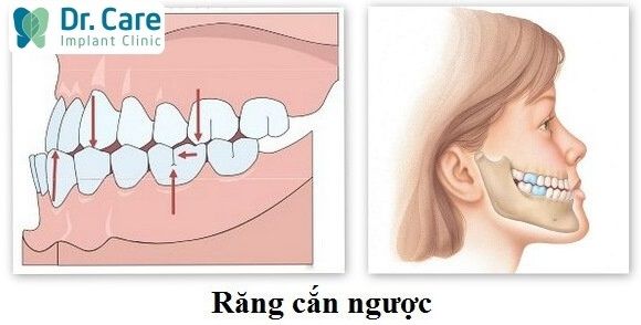 khớp cắn ngược là gì