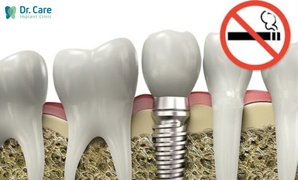 Trước khi trồng trụ Implant cần kiêng các chất kích thích