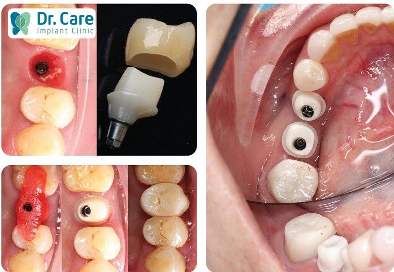 Custom Abutment có thể sử dụng với nhiều mão răng sứ không?