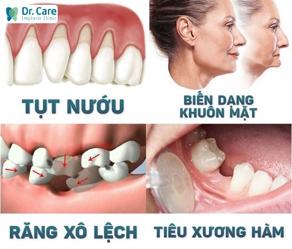 Mất 4 răng liên tiếp làm xuất hiện các bệnh lý khác