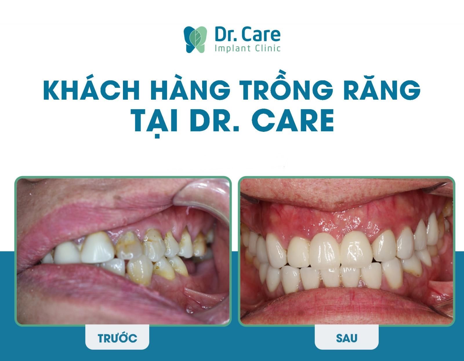 mất răng lâu năm có trồng răng sứ cố định được không