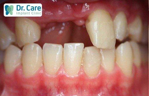 Mất răng lâu năm có trồng Implant được không