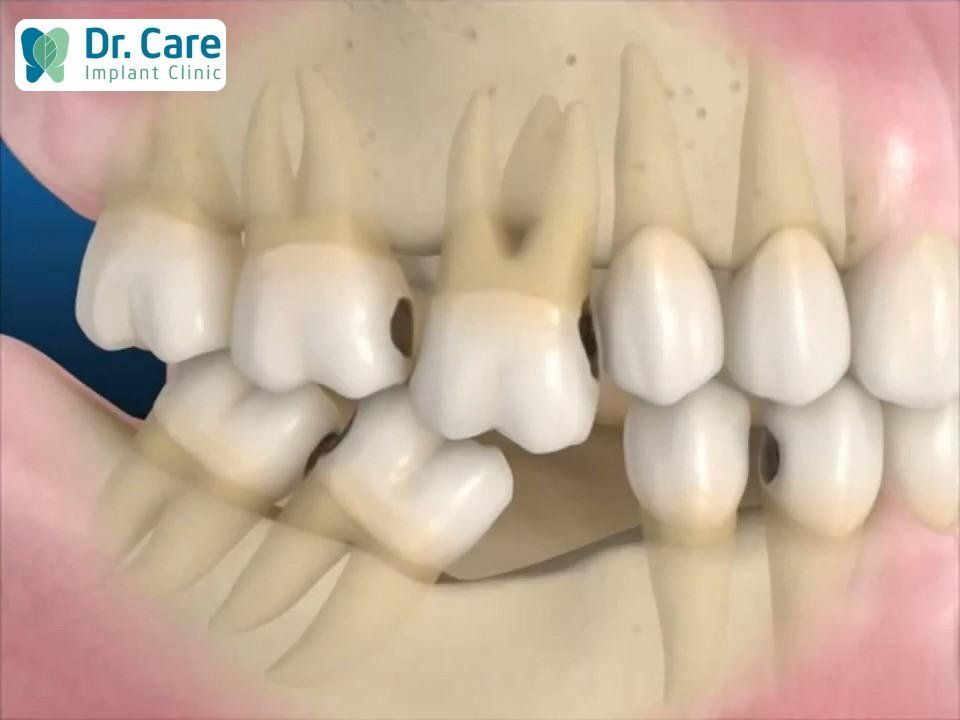 Tác hại của việc mất răng lâu năm