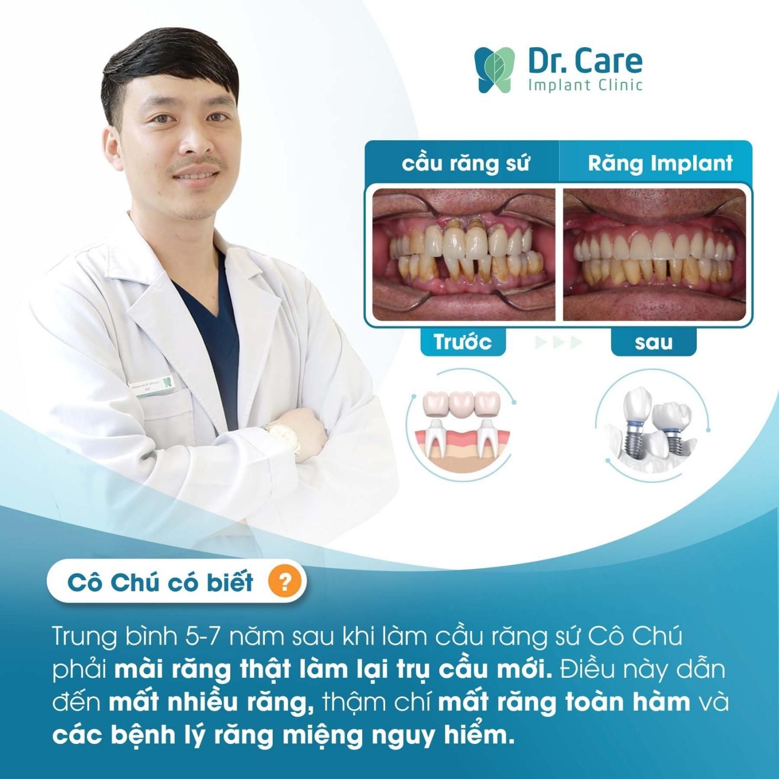 Ưu điểm của răng Implant so với cầu răng sứ