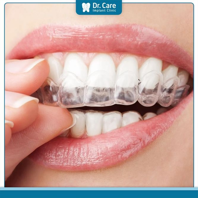 Chỉnh nha trong suốt Invisalign là phương pháp có chi phí cao nhất