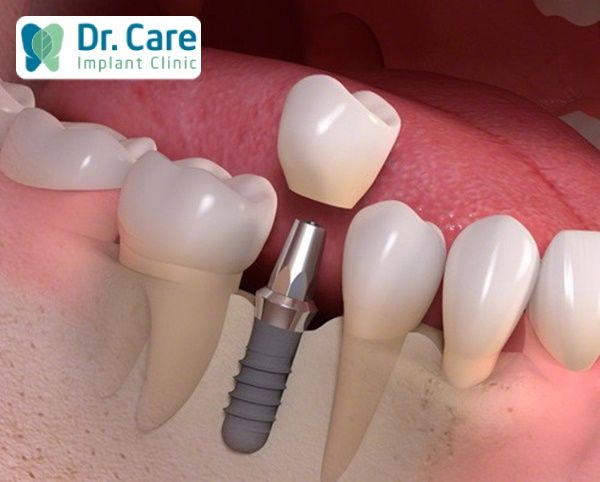 Niềng răng trước khi trồng răng Implant