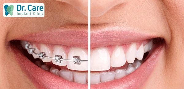 Lưu ý khi niềng răng sau khi cấy ghép Implant