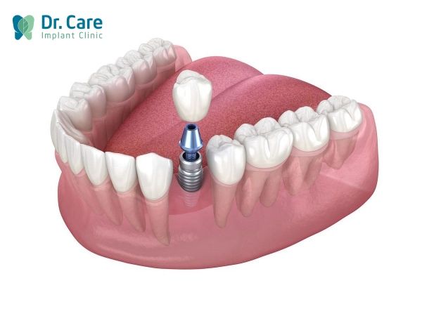 trồng răng Implant là gì