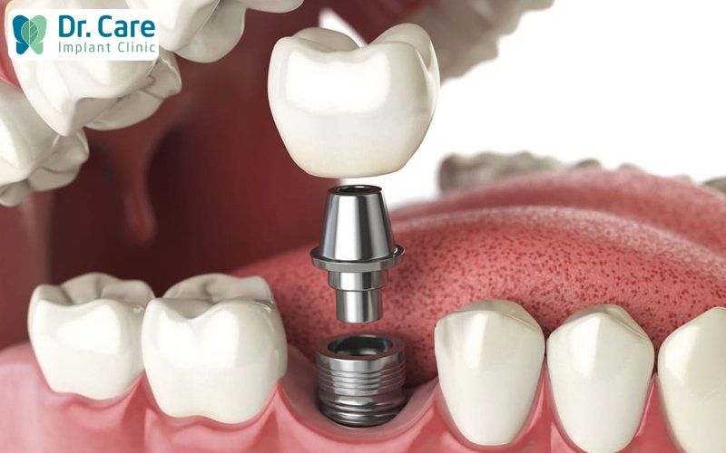 niềng răng trước hay trồng Implant trước