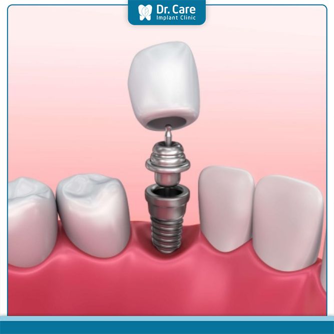 Phục hình răng sứ trên Implant
