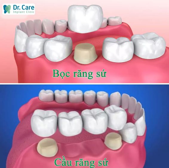 cầu răng sứ và bọc răng sứ