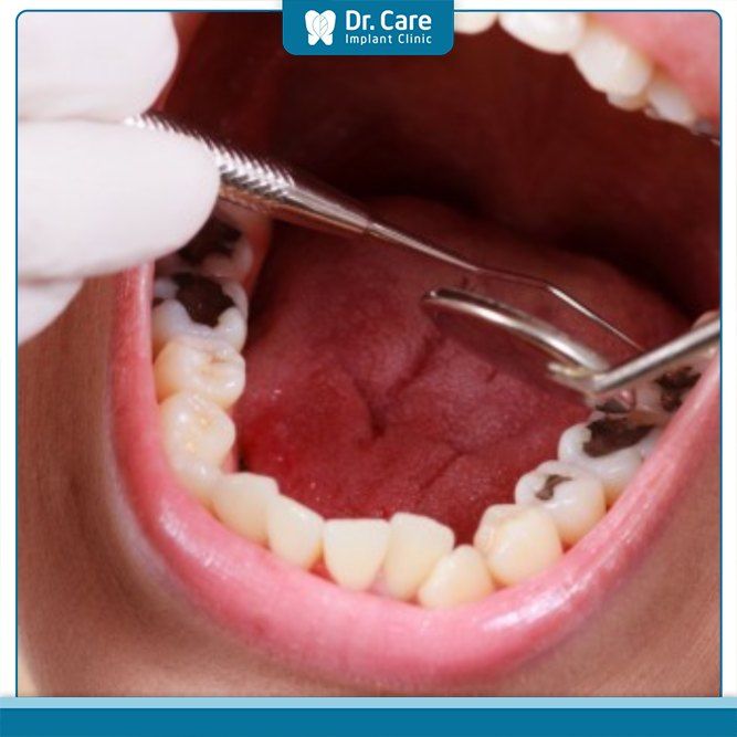 Có nhiều yếu tố ảnh hưởng đến chi phí trám răng