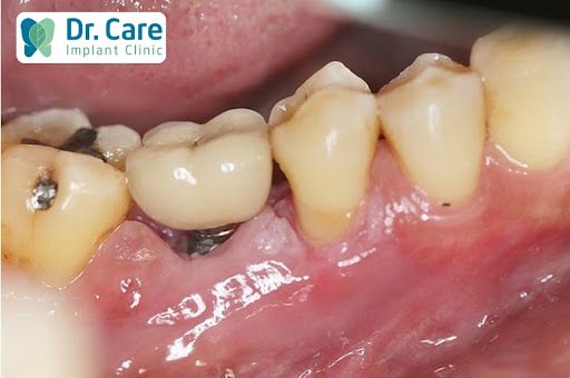 Tỉ lệ thất bại của người hút thuốc lá khi trồng răng Implant? 