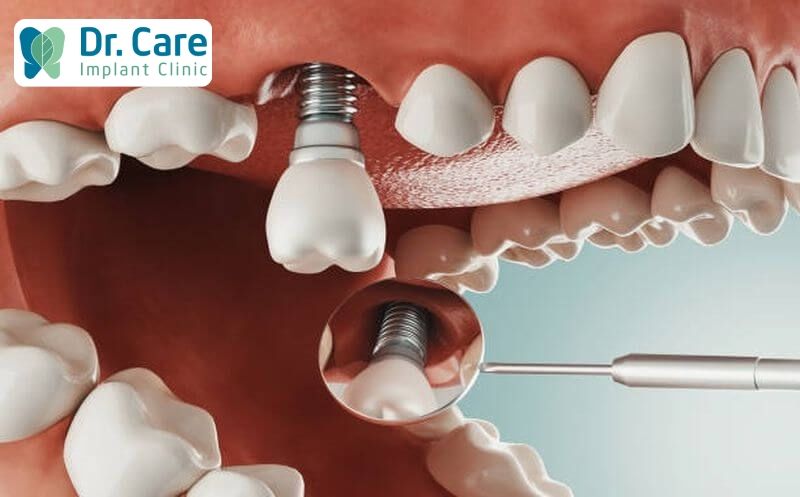 Vì sao không được cấy Implant khi chưa xét nghiệm máu