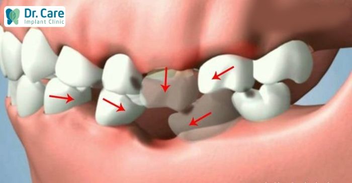 khắc phục tình trạng tiêu xương hàm