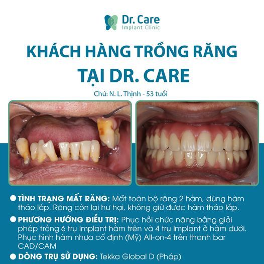 Những điều lưu ý trước và sau khi trồng răng Implant