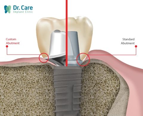 trụ Implant