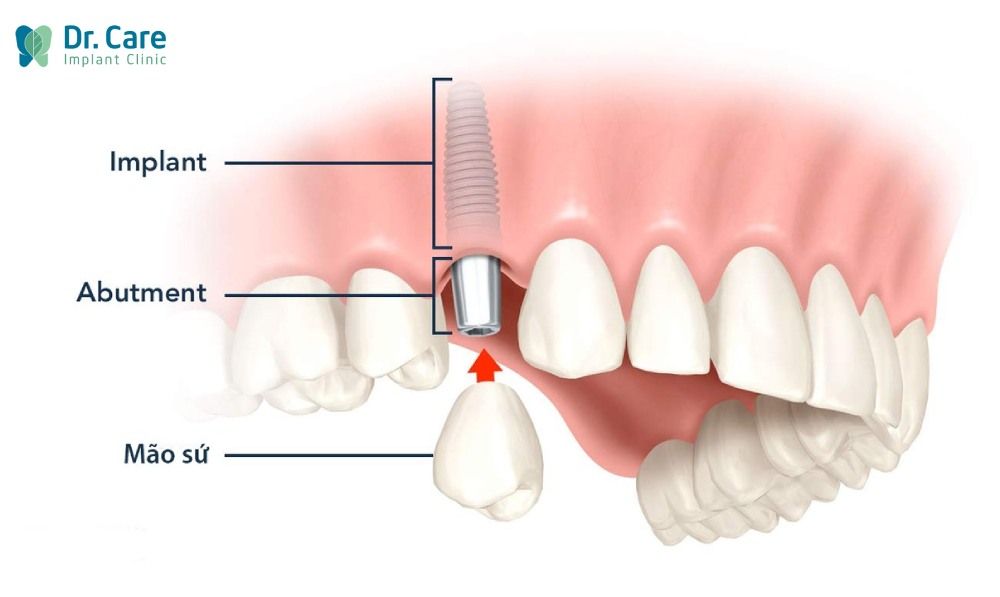 Rang-Implant-co-tuong-tu-nhu-rang-that-khong