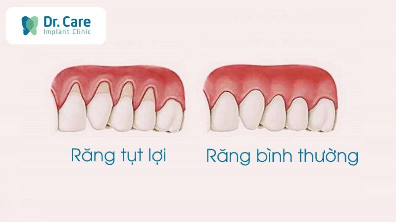 Tụt lợi chân răng có chữa được không