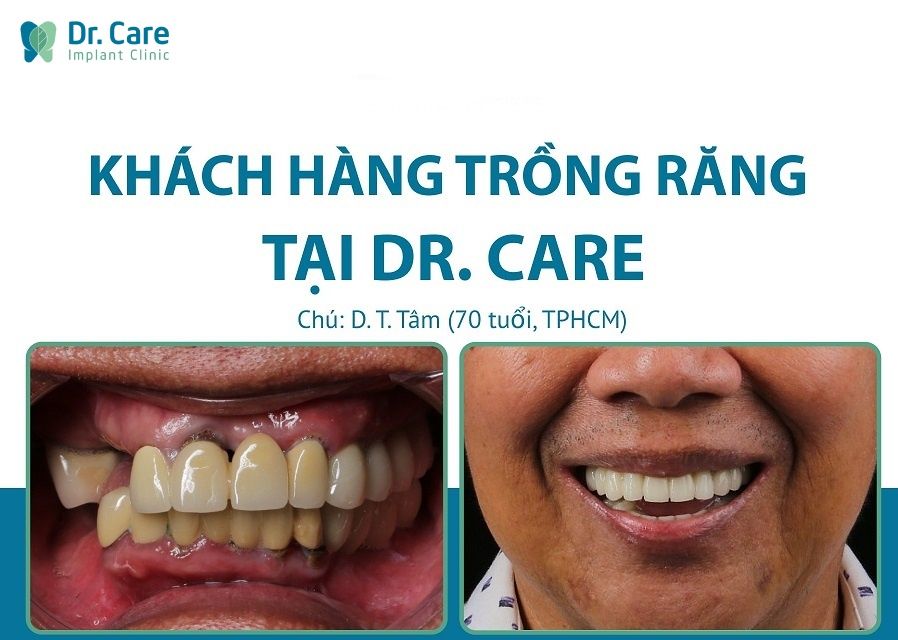 trồng răng Implant bao lâu thì lành