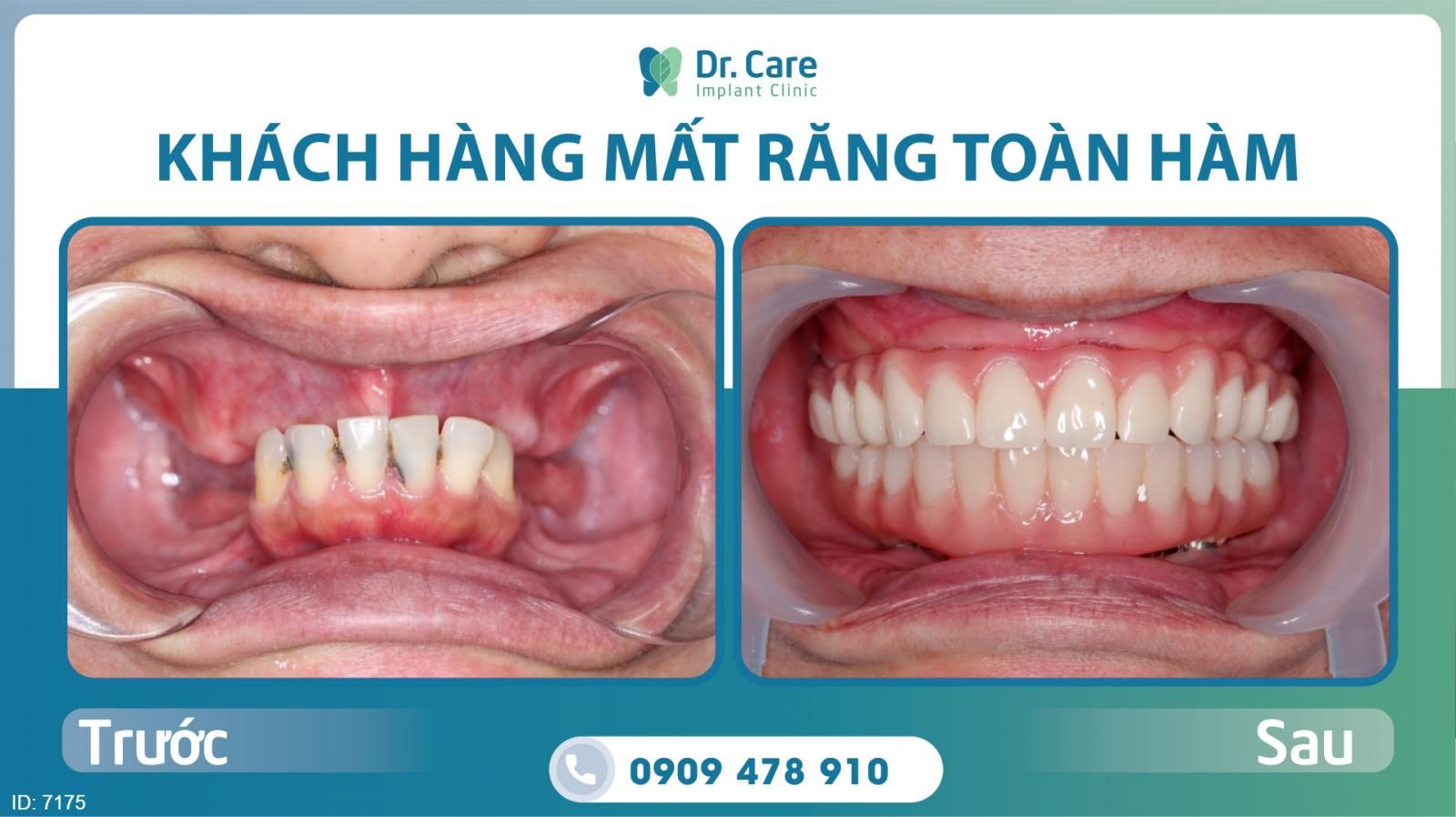 Trồng răng Implant toàn hàm giá bao nhiêu?