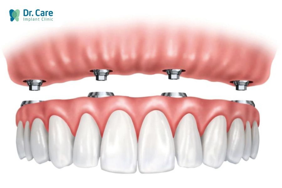 2. Hàm phủ trên Implant