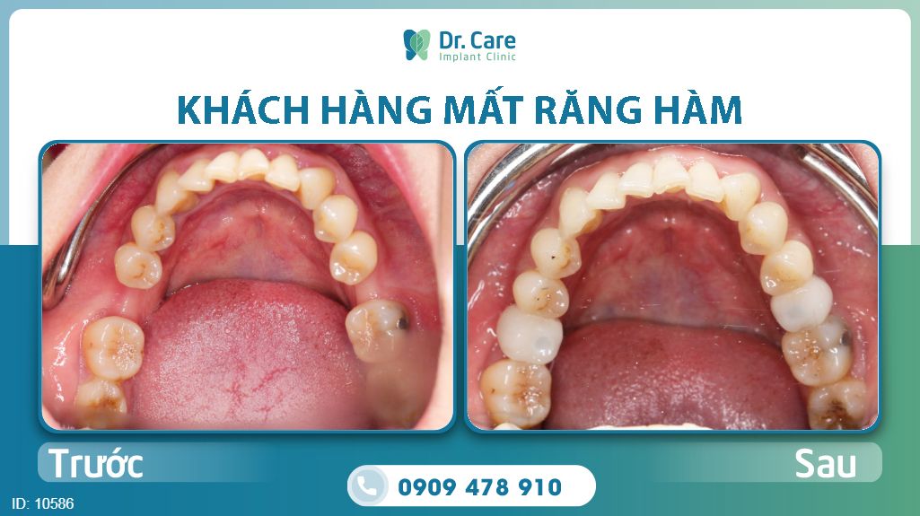 Trồng răng Implant đối với răng hàm bị gãy, chân răng lung lay