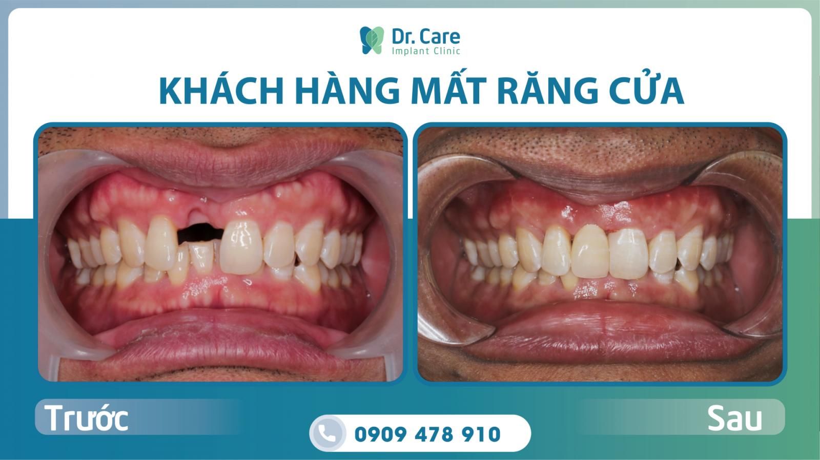 kỹ thuật trồng răng implant