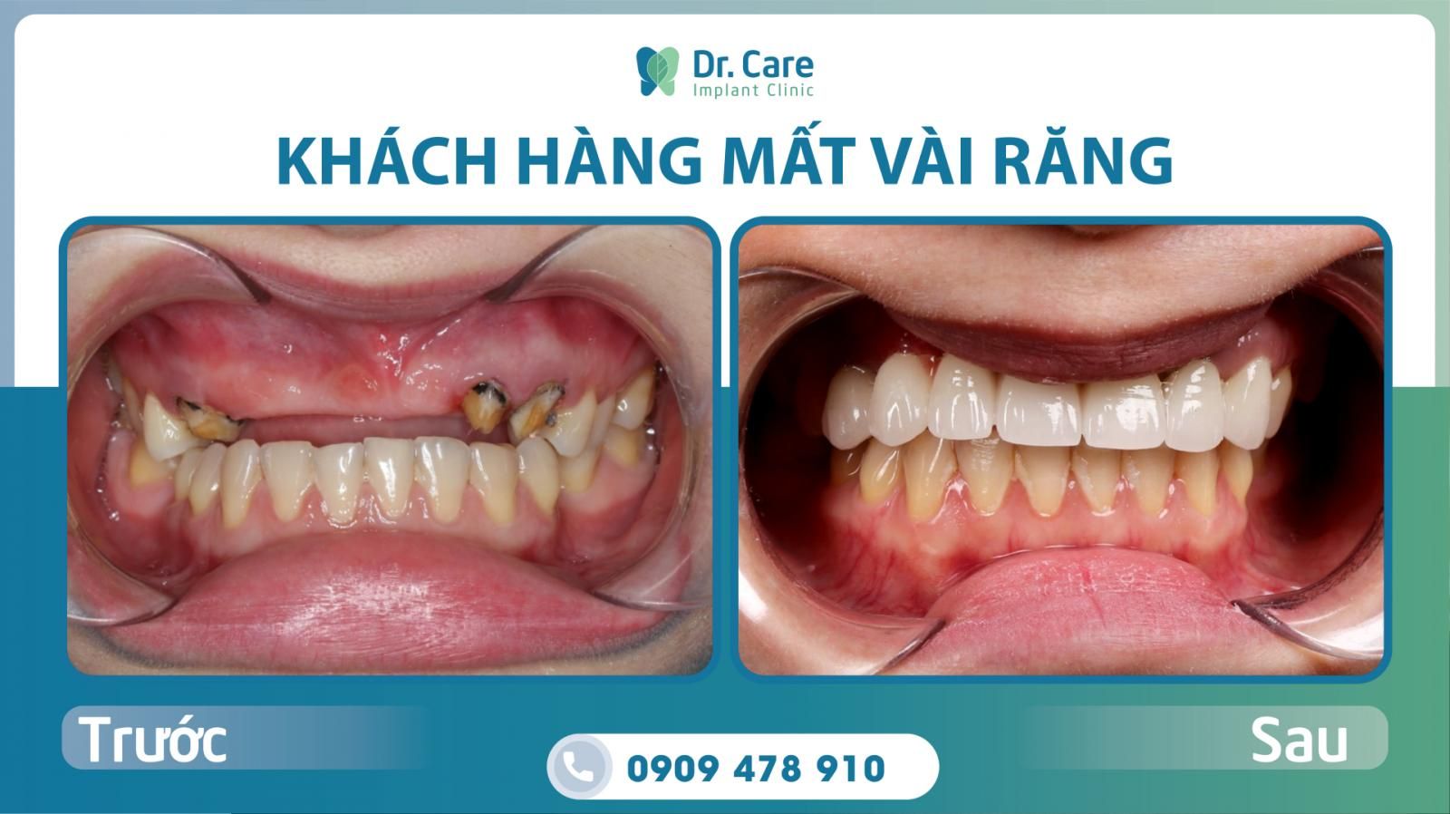 kỹ thuật trồng răng implant