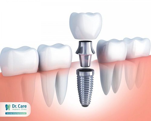 Ưu điểm của trồng răng Implant