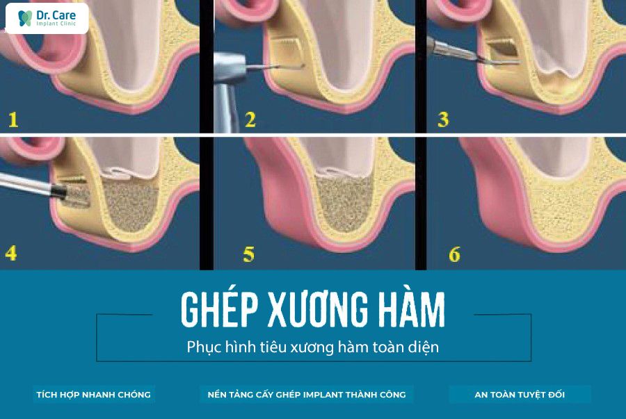 Ghép xương hàm