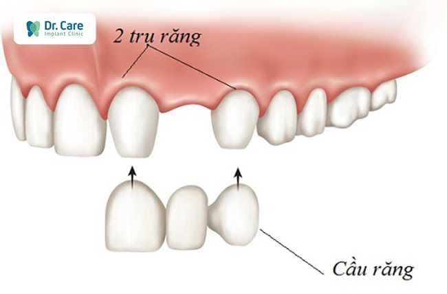 Làm cầu răng sứ như thế nào?