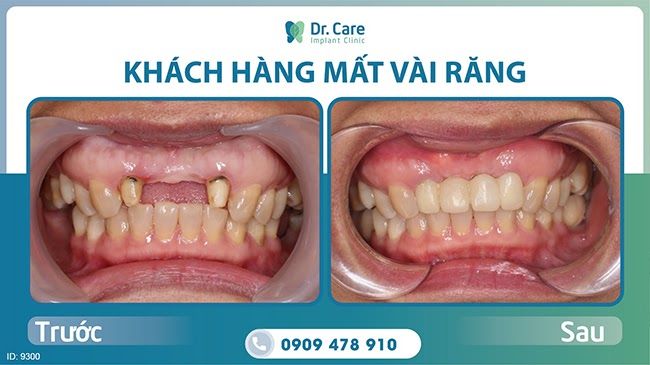 Nhược điểm của cầu răng sứ