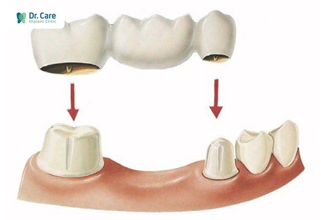  Những ưu, nhược điểm và chất lượng cầu răng sứ