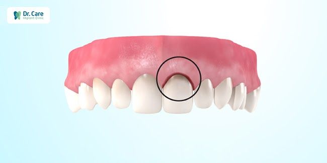 Nhược điểm của cầu răng sứ titan