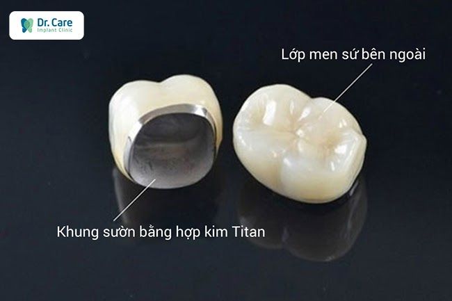 Ưu nhược điểm của cầu răng sứ titan