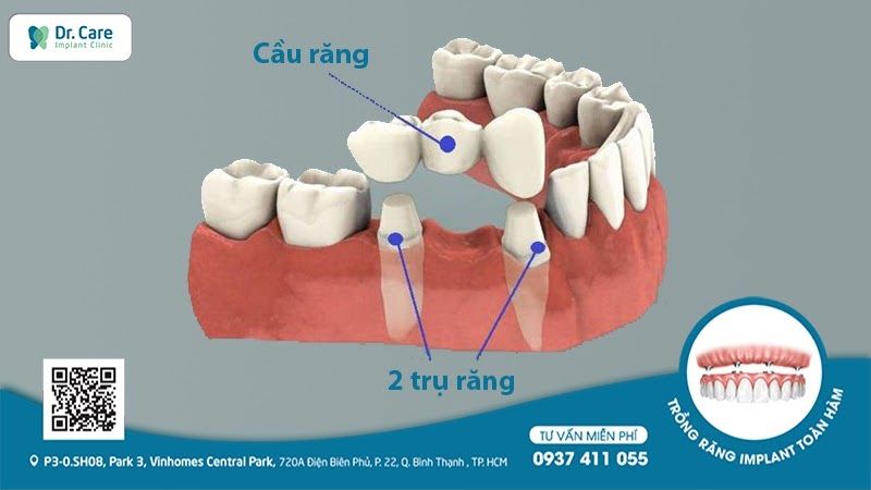 Những lưu ý khi làm cầu răng sứ răng cửa