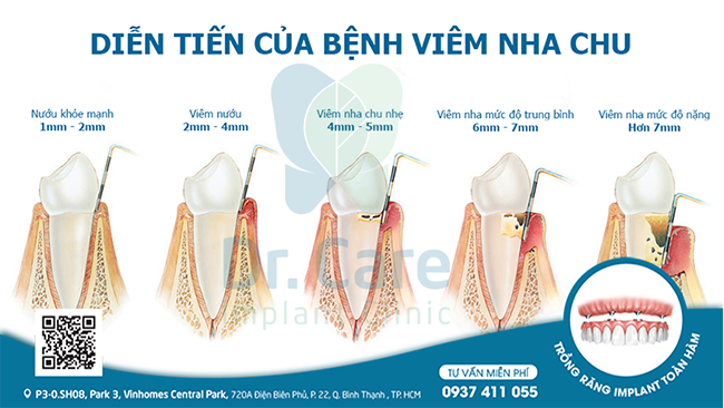 Diễn biến của bệnh viêm nha chu