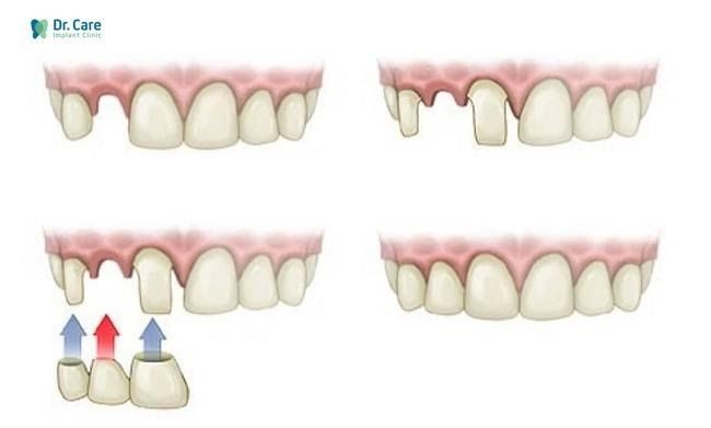 Cầu răng sứ sử dụng lâu ngày có tốt không dựa vào những yếu tố nào?