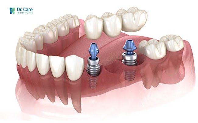 Trồng răng Implant thay thế cho cầu răng sứ