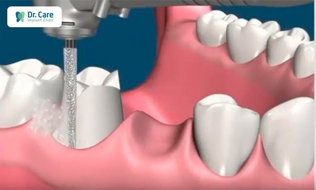 Nguyên nhân vì sao làm cầu răng sứ bị viêm lợi