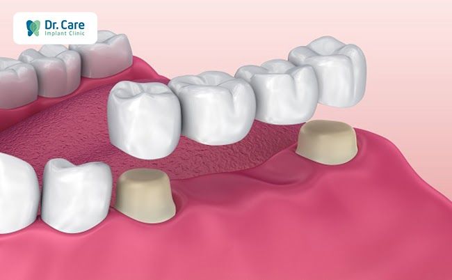  Làm cầu răng sứ có niềng răng được không?