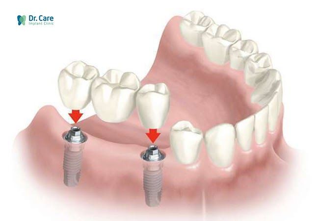 Trồng răng Implant hạn chế việc mẻ răng sứ