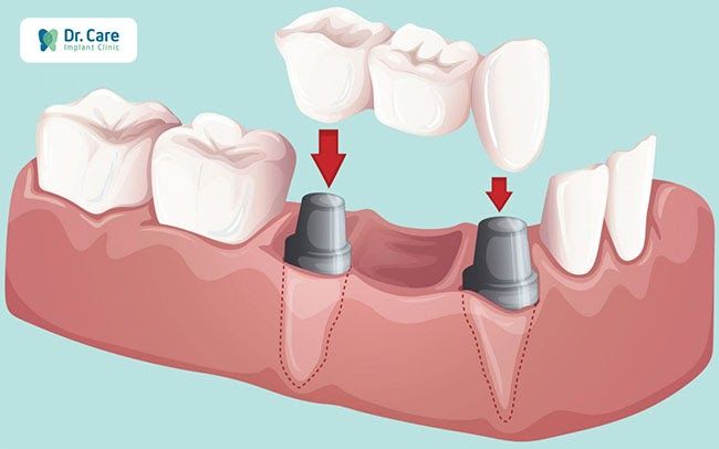 Thời gian làm cầu răng sứ phụ thuộc vào những yếu tố nào?