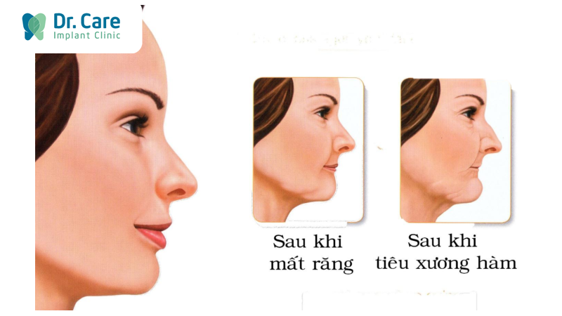 4 Hậu quả do mất răng số 5 lâu ngày