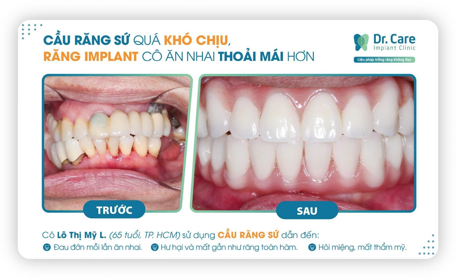 Ưu điểm trồng răng Implant