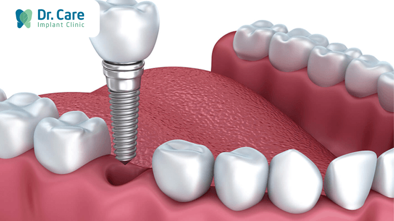 Phục hình sứ trên Implant là gì?