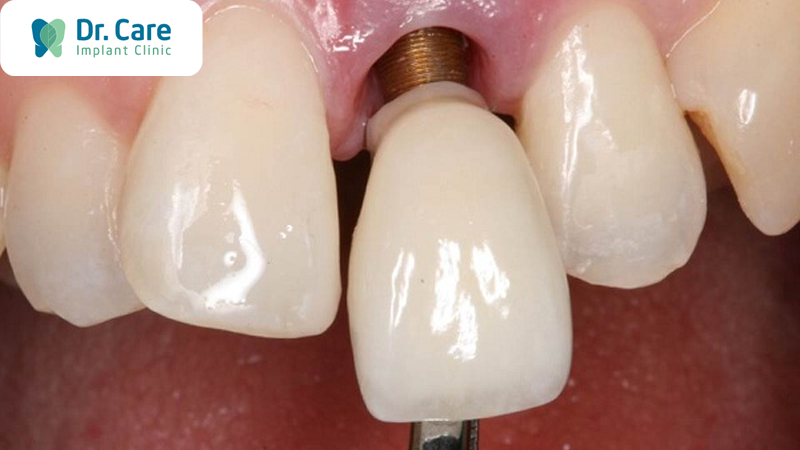 4 Biểu hiện cần thăm khám ngay sau khi đặt trụ Implant