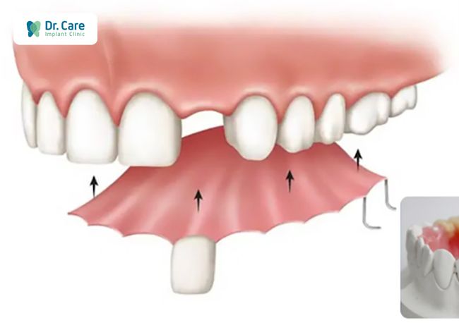 Răng tạm tháo lắp