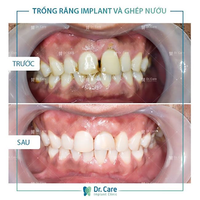 Tại sao phải thực hiện ghép nướu khi trồng Implant